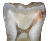 dentineCaries